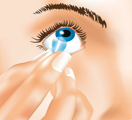 Kontaktlinse einsetzen